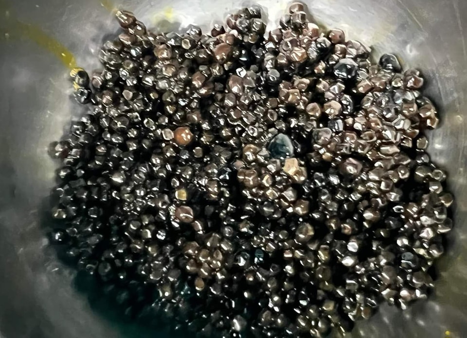 Người phụ nữ "tích" hàng ngàn viên sỏi mật trong cơ thể