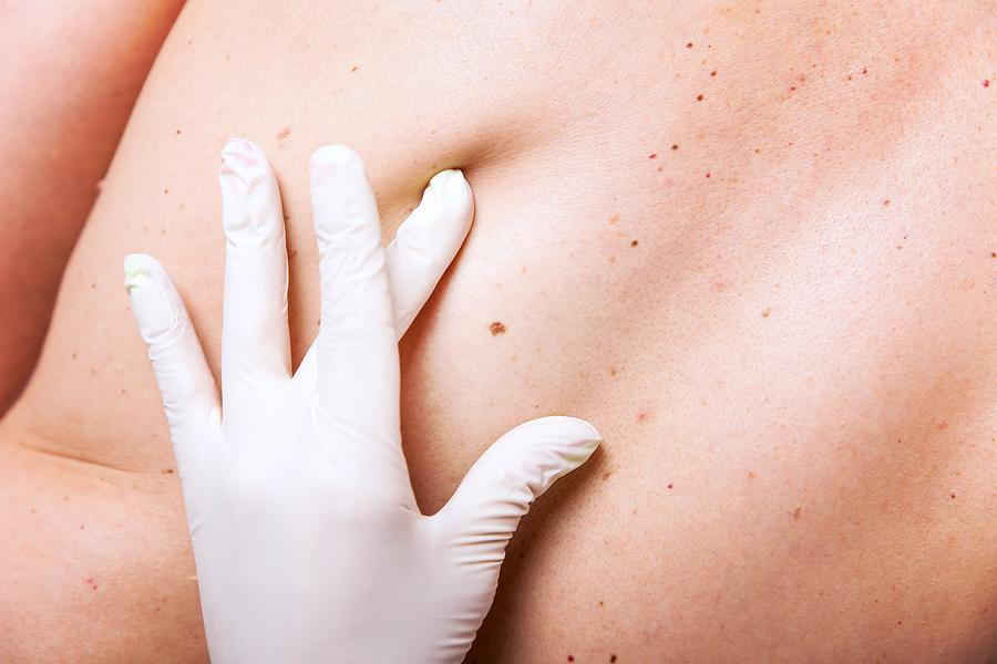 LƯU Ý: 5 bước tự phát hiện ung thư da
