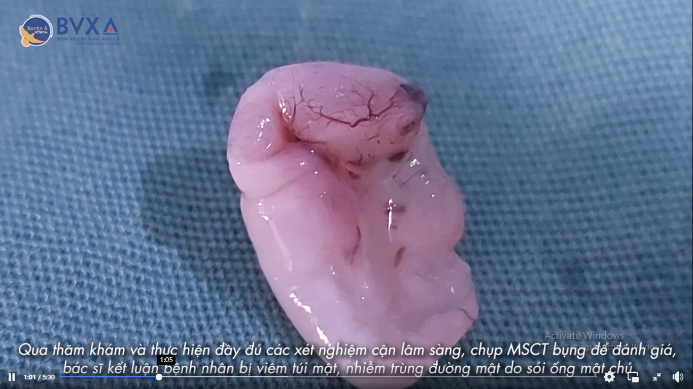 Bắt sán lá gan đang ngoe nguẩy trong bụng người đàn ông