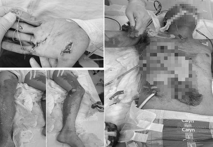 Dùng sào nhôm gỡ diều, nam thanh niên bị bỏng điện phức tạp