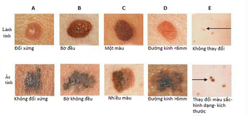 Những vị trí mọc nốt ruồi có thể tiến triển thành ung thư