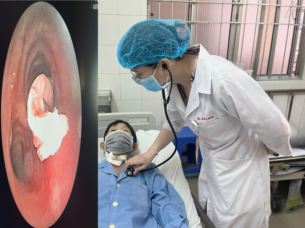 Nỗ lực lấy đoạn khăn giấy rớt vào phế quản bệnh nhân ung thư