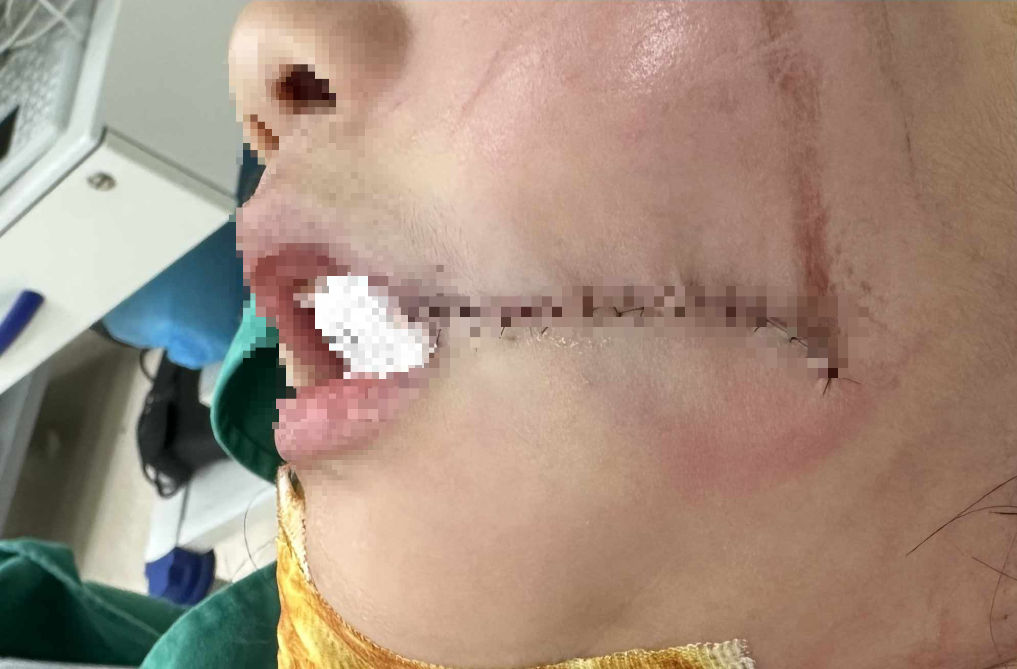 Bị thang m&aacute;y chở h&agrave;ng đập v&agrave;o mặt, b&eacute; g&aacute;i chấn thương nghi&ecirc;m trọng - Ảnh 1.