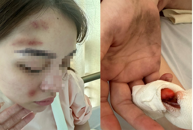 Một cảnh sát hình sự bị bạn gái "tố" hành hung gây thương tích
