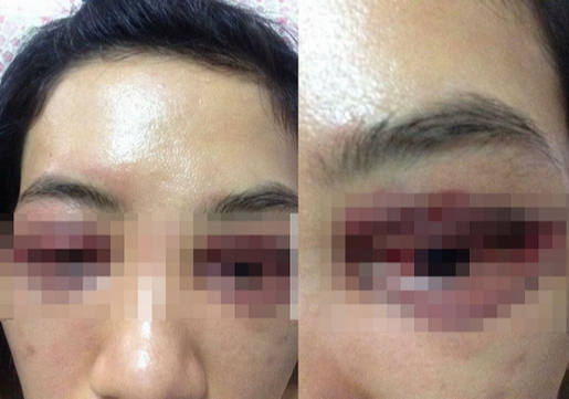 Suýt hỏng mắt vì làm mẫu cho học viên spa cắt mí