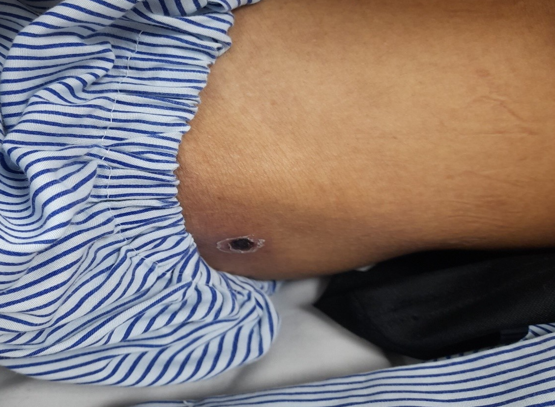 Tổn thương gan, thận cấp, phải thở máy vì vết đốt nhỏ