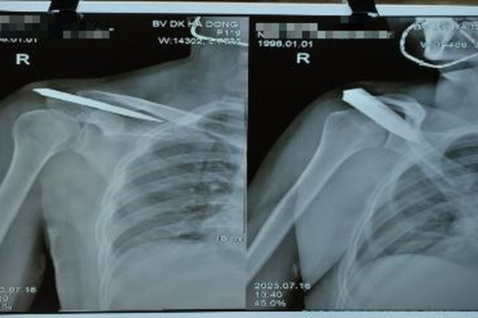 M&acirc;u thuẫn gia đ&igrave;nh, nam thanh ni&ecirc;n bị đ&acirc;m g&atilde;y dao - Ảnh 1.