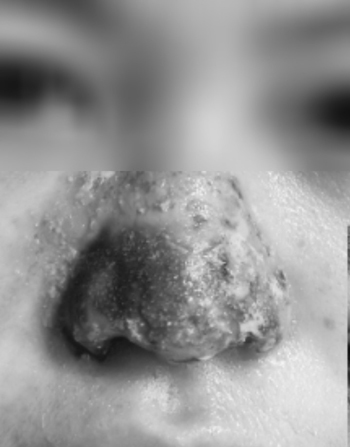 Hiểm họa khi ti&ecirc;m filler tr&agrave;n lan - Ảnh 1.