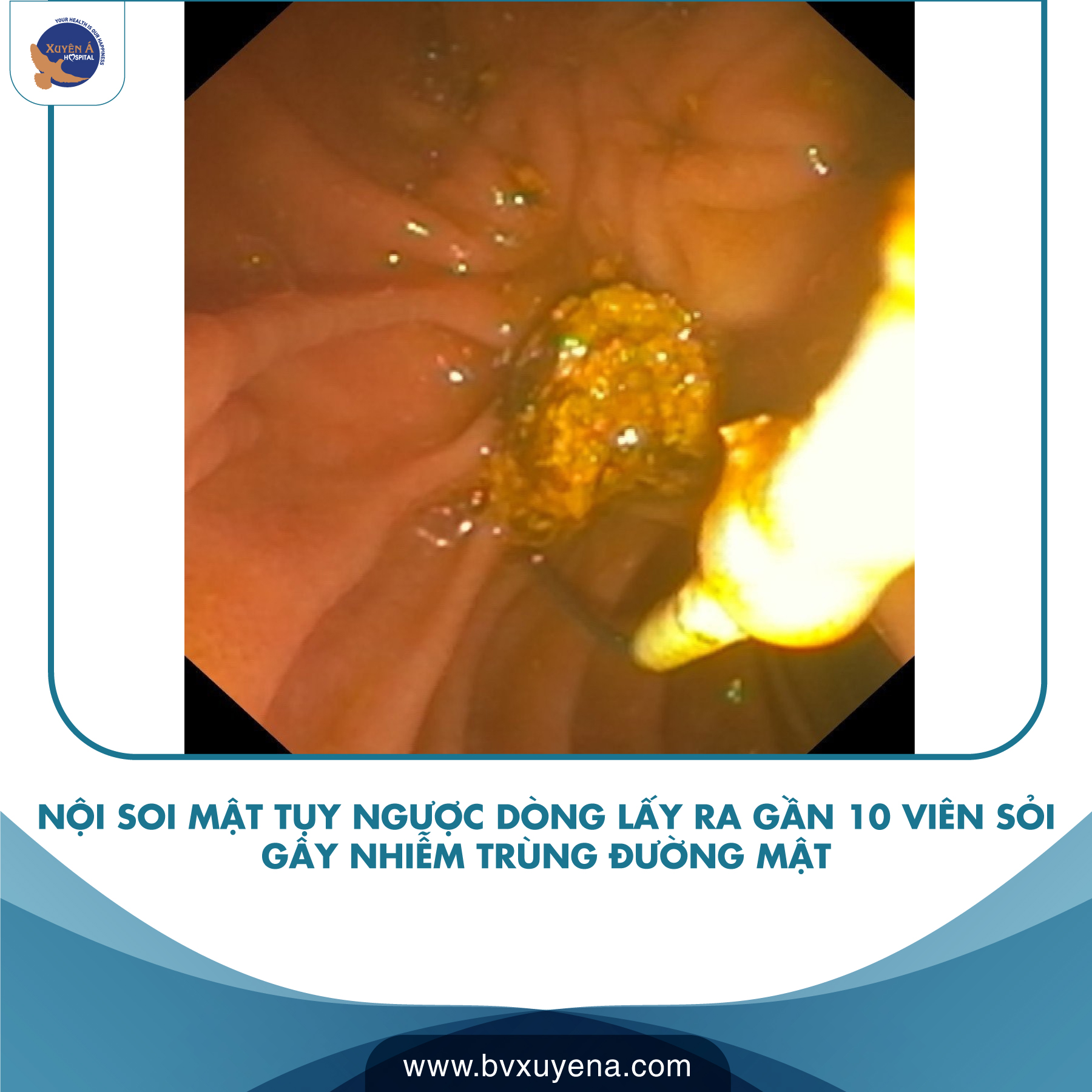 Nguy kịch vì bụng chứa hàng chục viên sỏi