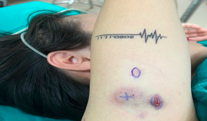 Tiêm tan mỡ giảm béo, cô gái trẻ nổi u cục khắp người - Ảnh 3.