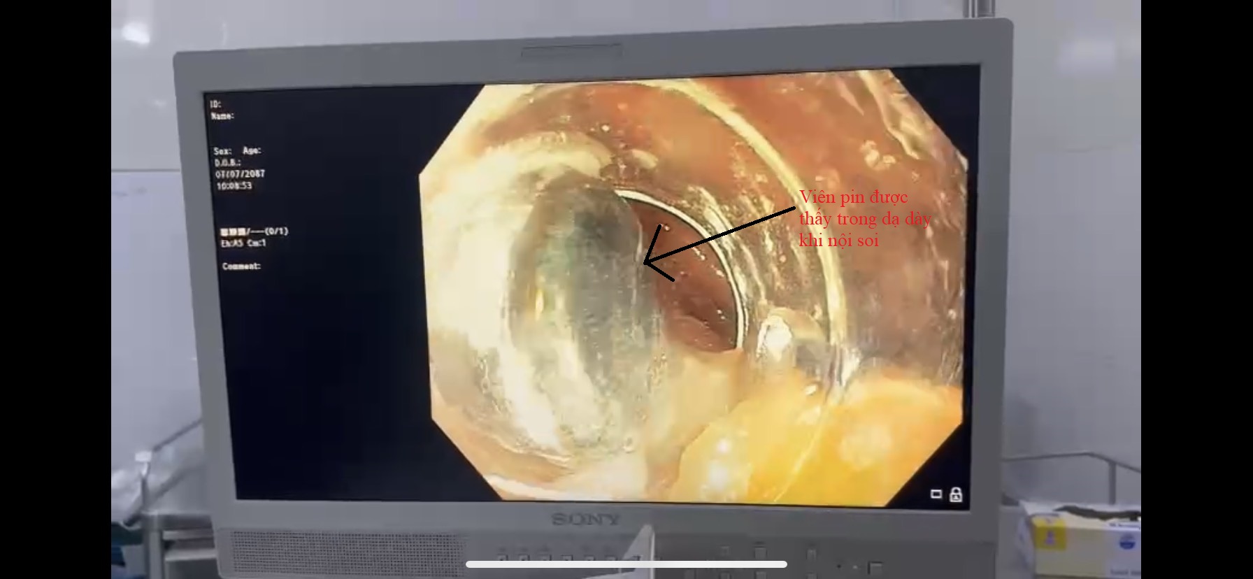 Bé trai may mắn vì viên pin trong bụng chưa vỡ - Ảnh 1.