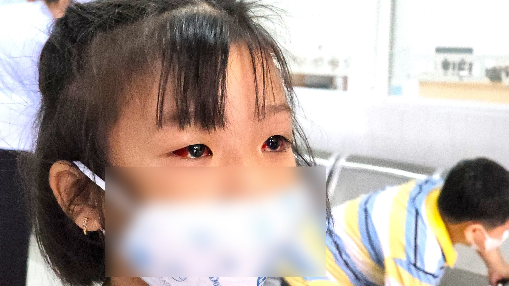 Bệnh viện Nhi đồng 2: Hàng chục ca đau mắt đỏ đến khám mỗi ngày