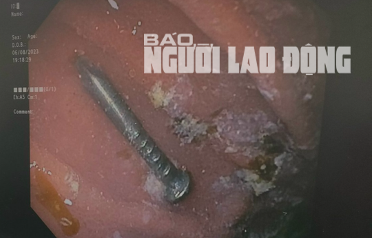 Bé trai gặp nguy hiểm khi nuốt cây đinh lúc đang chơi đùa