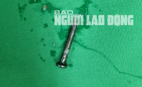B&eacute; trai gặp nguy hiểm khi nuốt c&acirc;y đinh l&uacute;c đang chơi đ&ugrave;a - Ảnh 2.