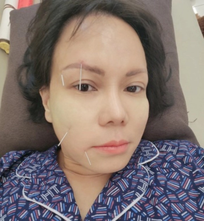 Vài sao Việt không may bị liệt nửa mặt, có người đứng trước nguy cơ đột quỵ