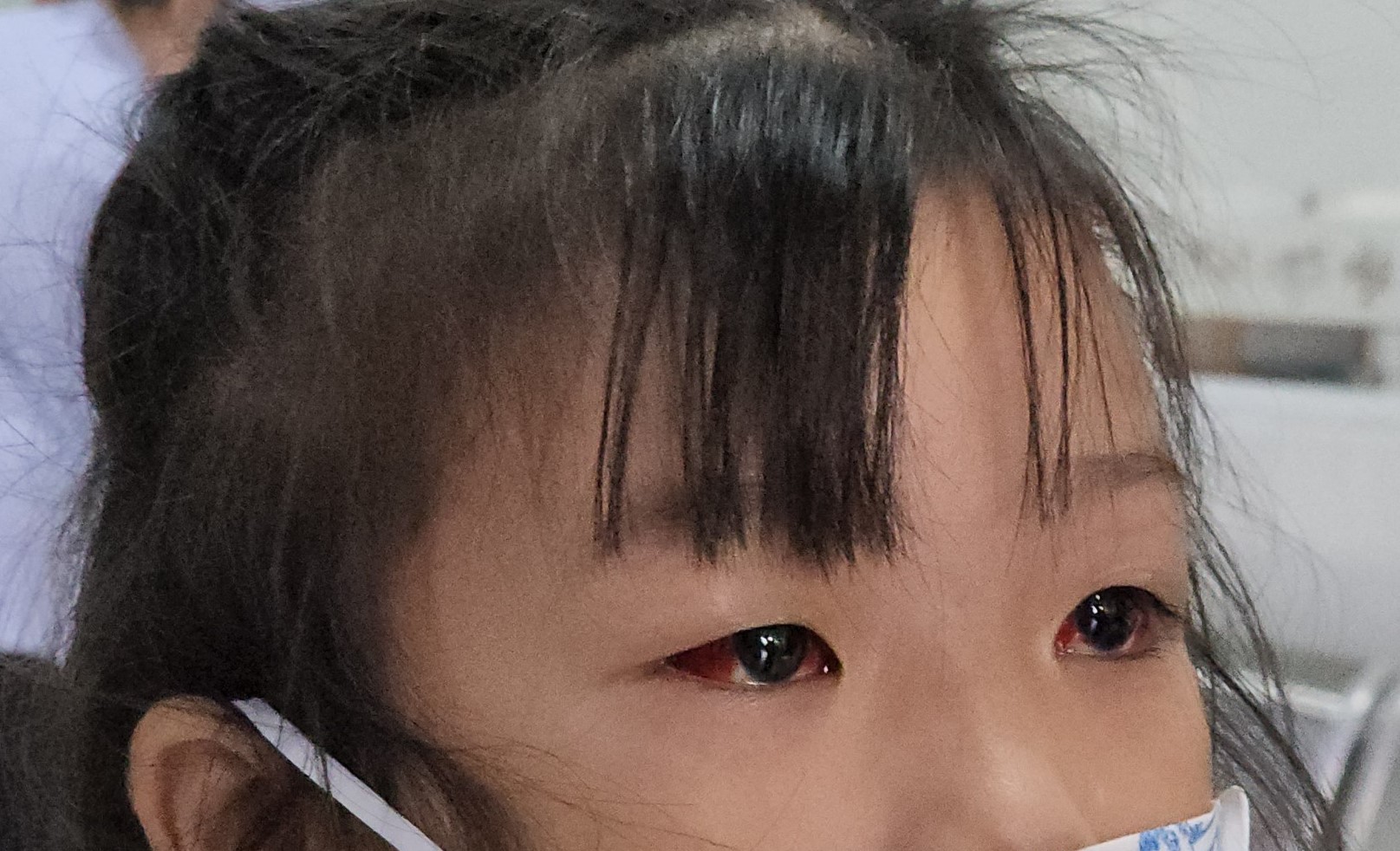 Đau mắt đỏ có lây qua đường uống?