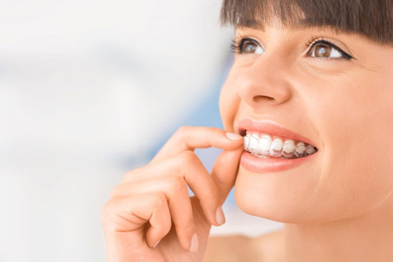 Tại sao phải đánh răng nhiều lần khi niềng răng bằng máng?