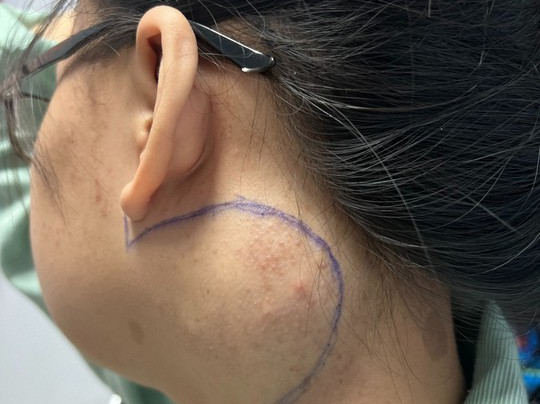 Cắt bỏ khối u ở vị trí nguy hiểm của cô gái 18 tuổi