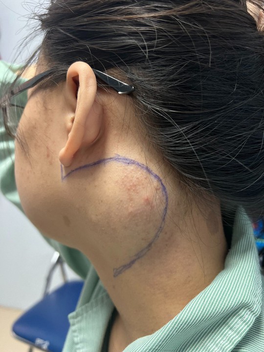 Cắt bỏ khối u ở vị tr&iacute; hiểm cho c&ocirc; g&aacute;i 18 tuổi - Ảnh 1.