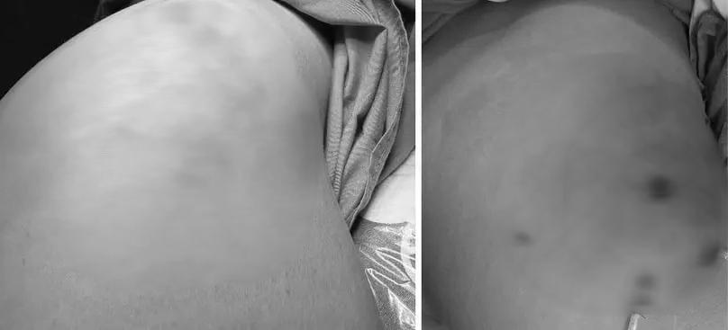 "Vòng 3" biến thành ổ mủ sau nhiều năm tiêm filler - Ảnh 1.