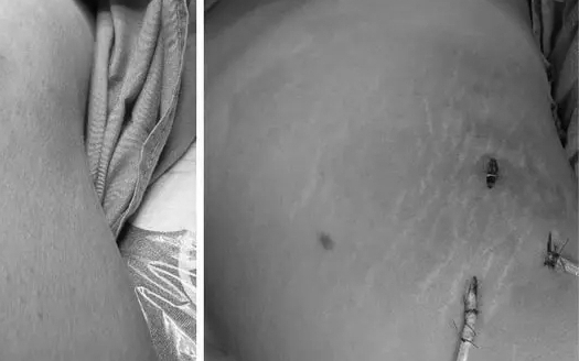 "Vòng 3" biến thành ổ mủ sau nhiều năm tiêm filler