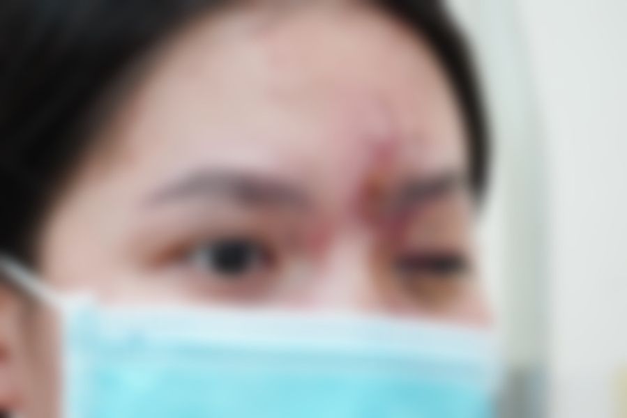 Cô gái trẻ mù mắt sau tiêm chất làm đẹp- Ảnh 1.