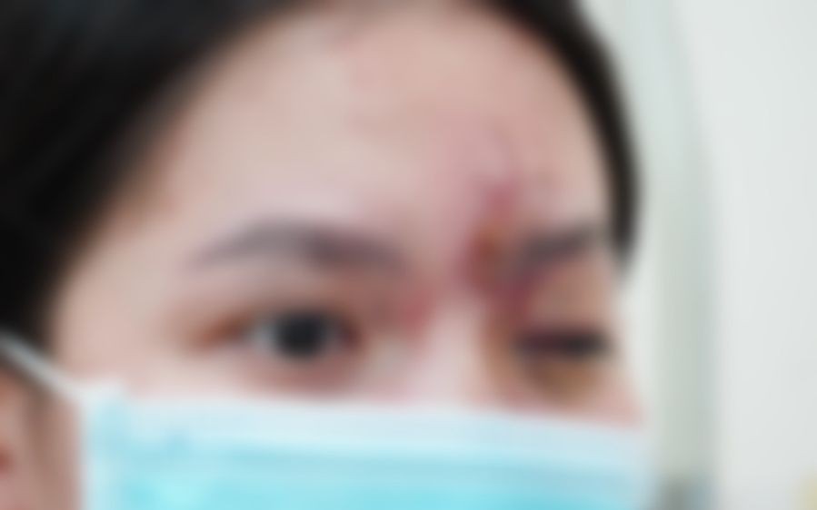 C&ocirc; g&aacute;i trẻ m&ugrave; mắt sau ti&ecirc;m chất l&agrave;m đẹp