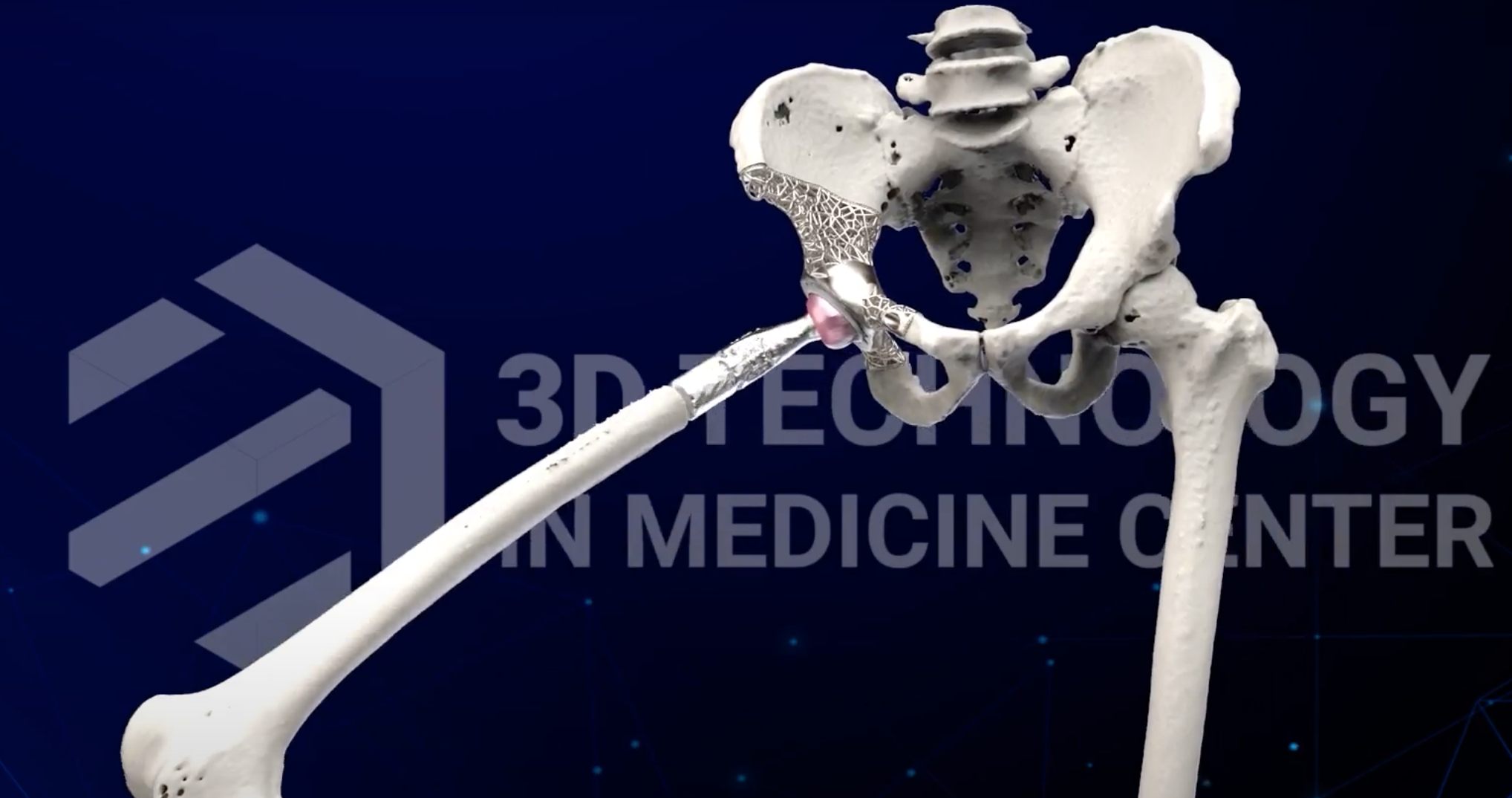 B&aacute;c sĩ tự thiết kế xương nh&acirc;n tạo cứu bệnh nh&acirc;n ung thư xương- Ảnh 2.