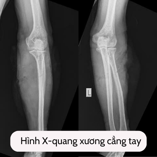 Người đ&agrave;n &ocirc;ng bị m&aacute;y cưa sắt cắt tay phải nối lại mạch m&aacute;u, d&acirc;y thần kinh- Ảnh 1.