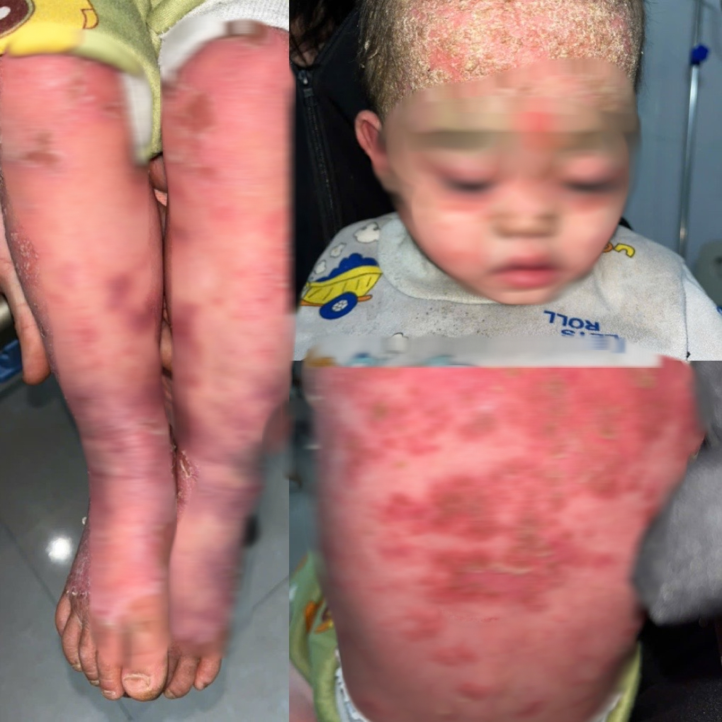 Bé trai 23 tháng tuổi loét toàn thân do gia đình tự chữa vảy nến- Ảnh 1.