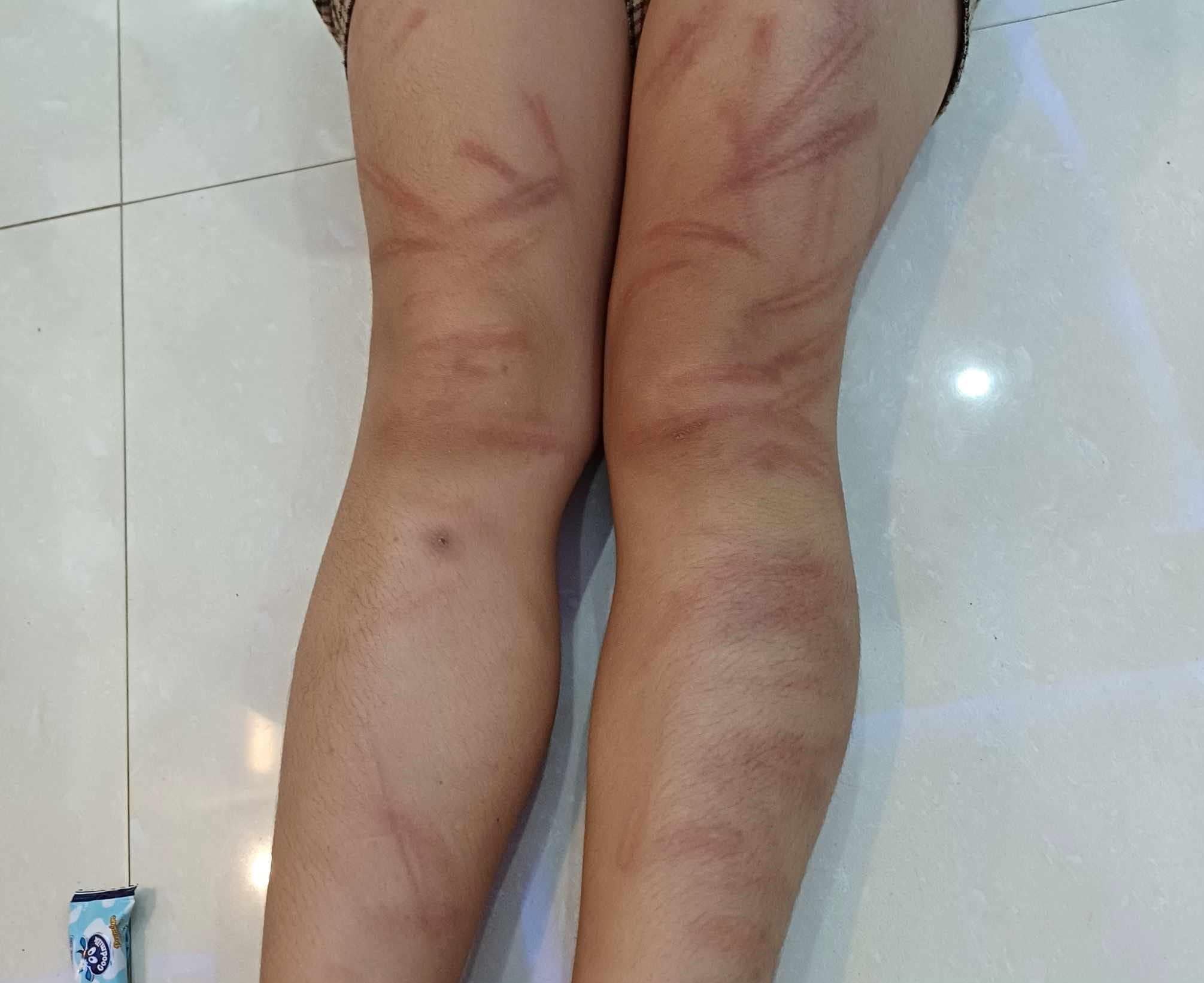 Vụ nhiều học sinh mầm non bị đánh bầm tím: Đánh các bạn là bé gái 5 tuổi - Ảnh 3.