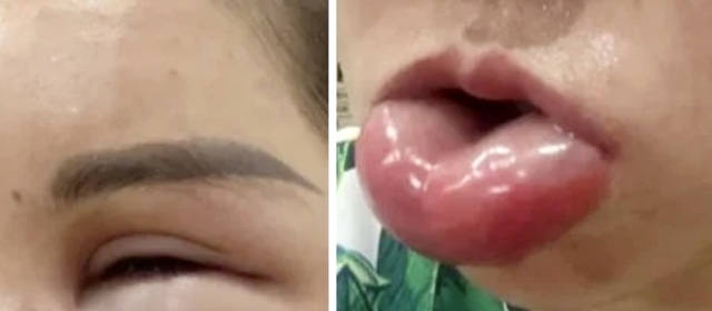 Thẩm mỹ tr&aacute;i ph&eacute;p, g&acirc;y tai biến: Bộ Y tế y&ecirc;u cầu kiểm tra- Ảnh 3.