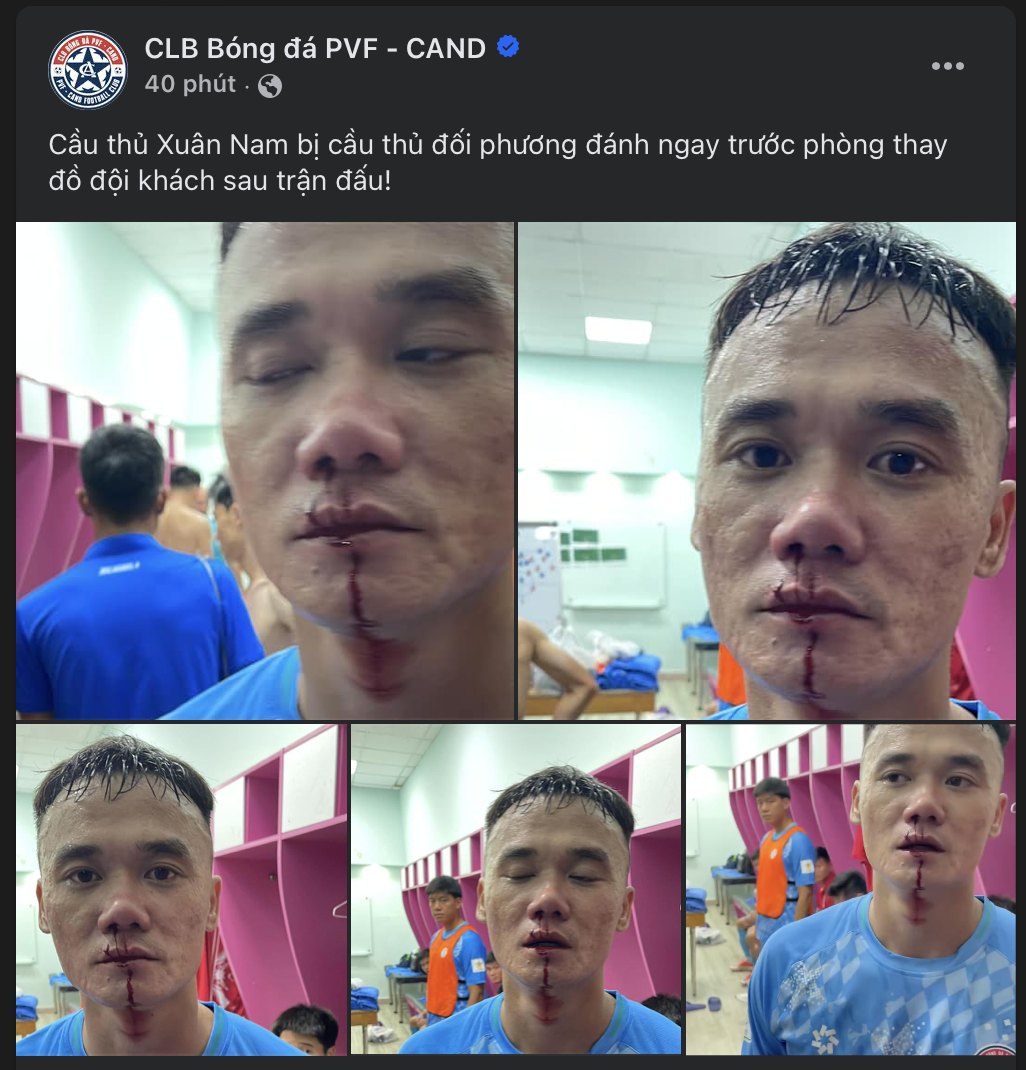 Xuân Nam bị đánh rách môi, hai đội PVF - CAND và Trẻ TP HCM tố nhau- Ảnh 1.