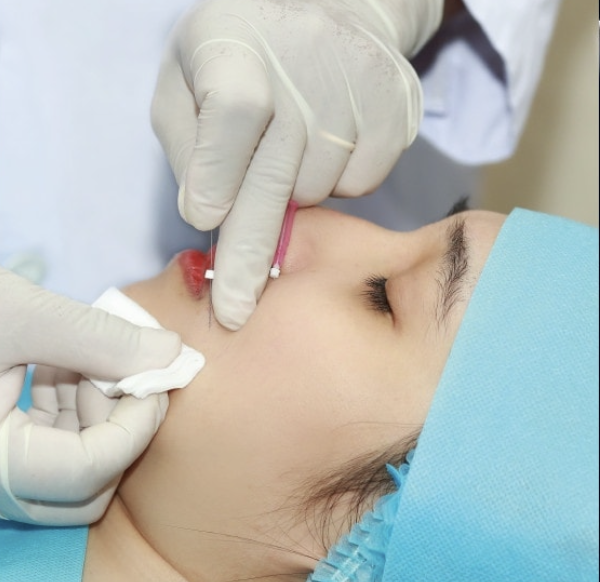 Cấy chỉ l&agrave; định hướng chuy&ecirc;n s&acirc;u về y học cổ truyền tại TP HCM- Ảnh 2.