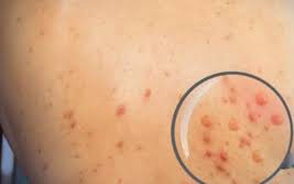 Cà Mau ghi nhận trường hợp mắc bệnh đậu mùa khỉ
