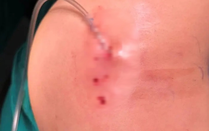 Vòng 3 chảy mủ sau tiêm filler