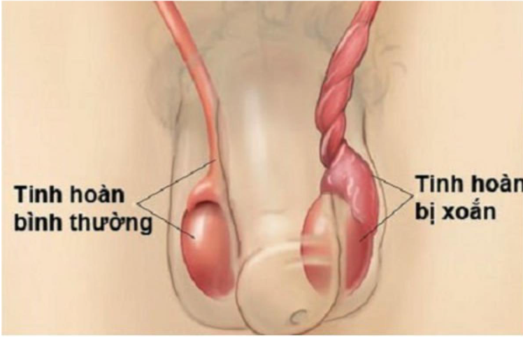 Những cơn đau “vùng kín” khiến nam giới phải cắt bỏ tinh hoàn- Ảnh 1.