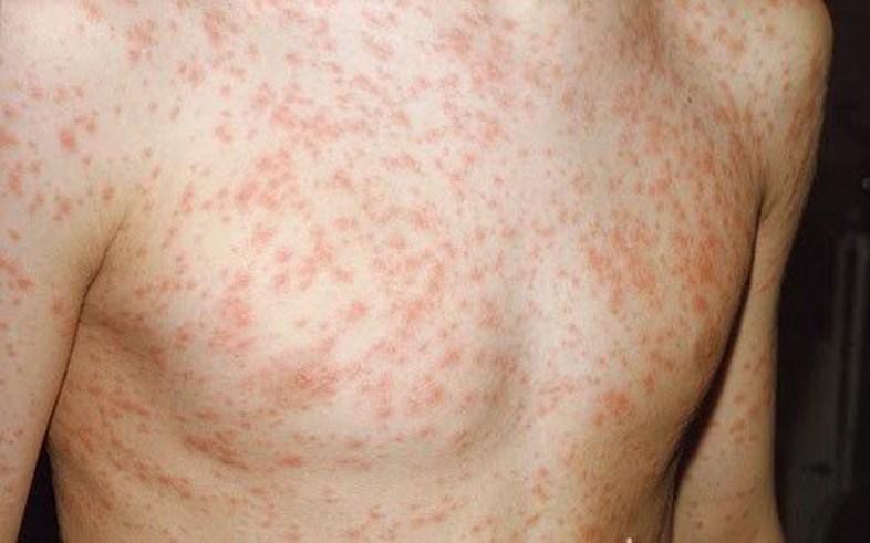 Bệnh sởi tăng đột biến, phòng bệnh thế nào?