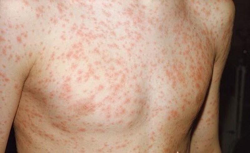 Bệnh sởi tăng đột biến, ph&ograve;ng bệnh thế n&agrave;o?- Ảnh 1.