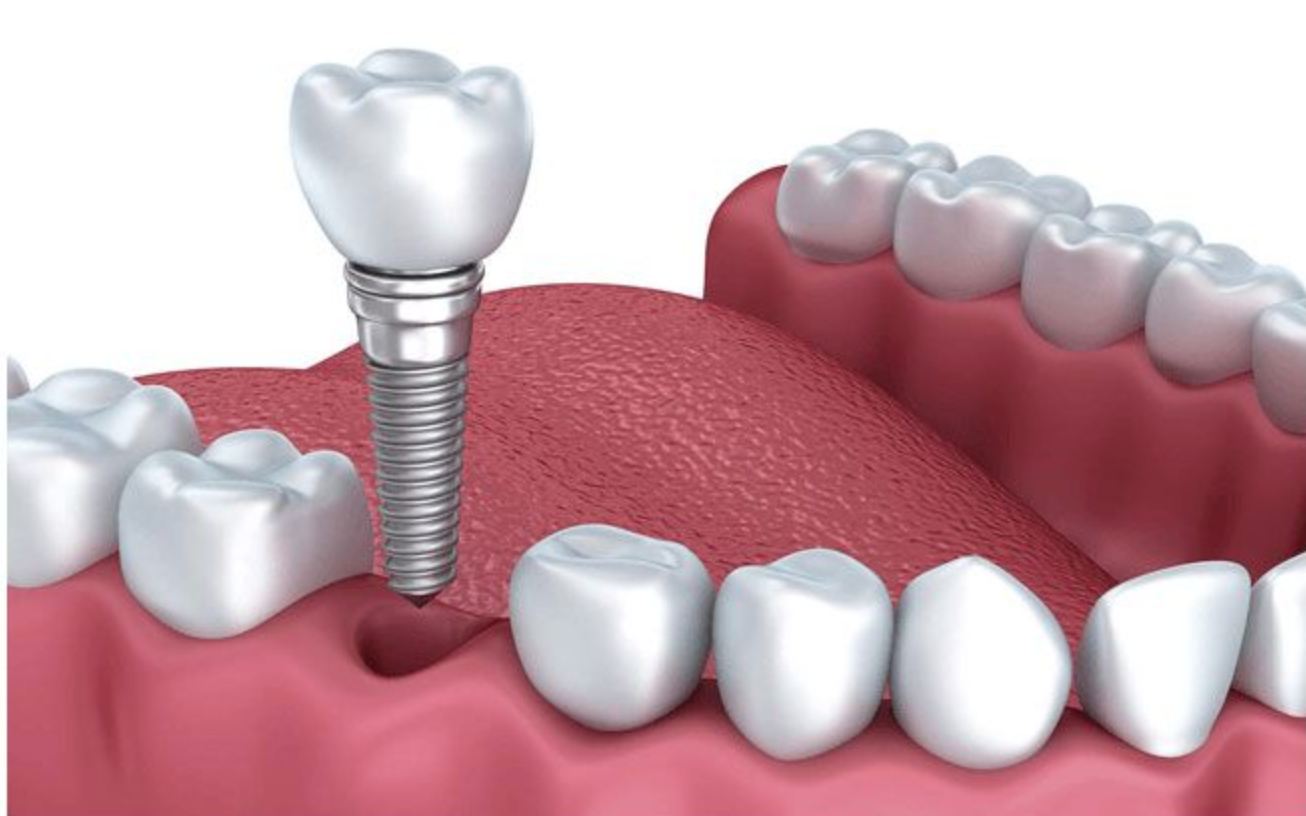 Bác sĩ tại nha khoa Amber chia sẻ kinh nghiệm chọn implant phù hợp- Ảnh 2.