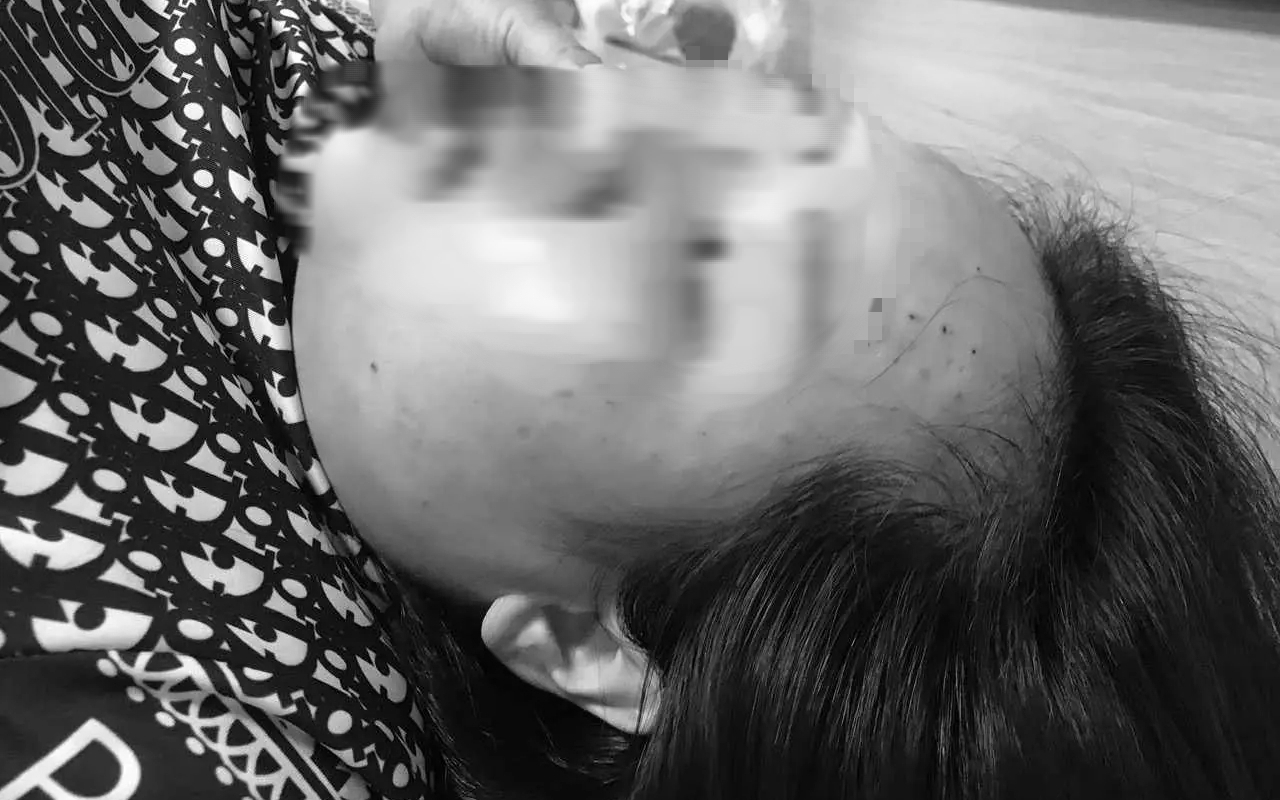 Tiêm nhầm sữa rửa mặt vào da cho khách