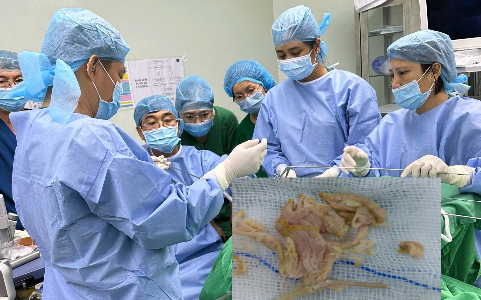 Ớn lạnh mảnh xương gà nhiều ngạnh cắm vào thực quản cụ ông ở Cần Thơ