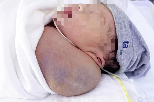 Bé trai mắc khối u nặng gần ⅓ cơ thể - Ảnh 1.