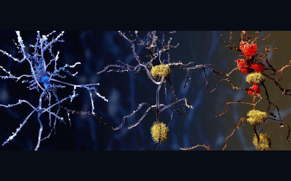 Phát hiện thủ phạm tiềm năng mới của bệnh Alzheimer