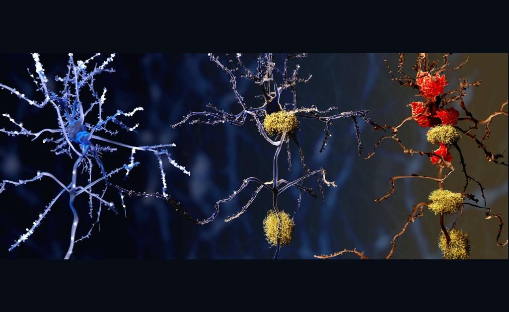 Ph&aacute;t hiện thủ phạm tiềm năng mới của bệnh Alzheimer- Ảnh 1.