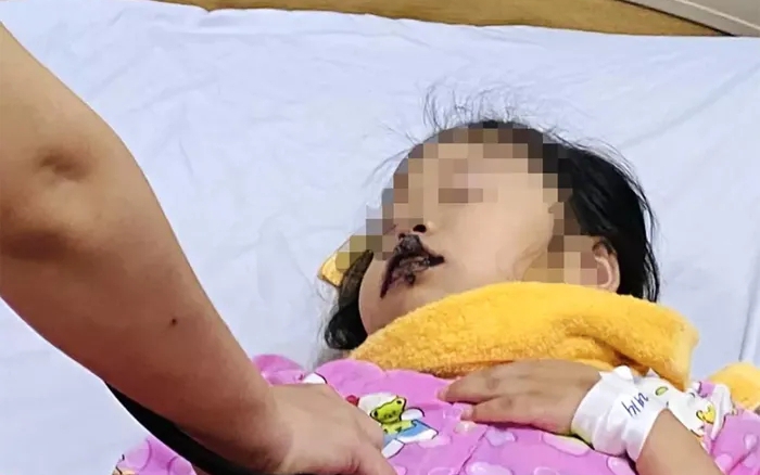 Nhầm tưởng là đường ăn, bé 5 tuổi nhập viện do nuốt xút ăn da