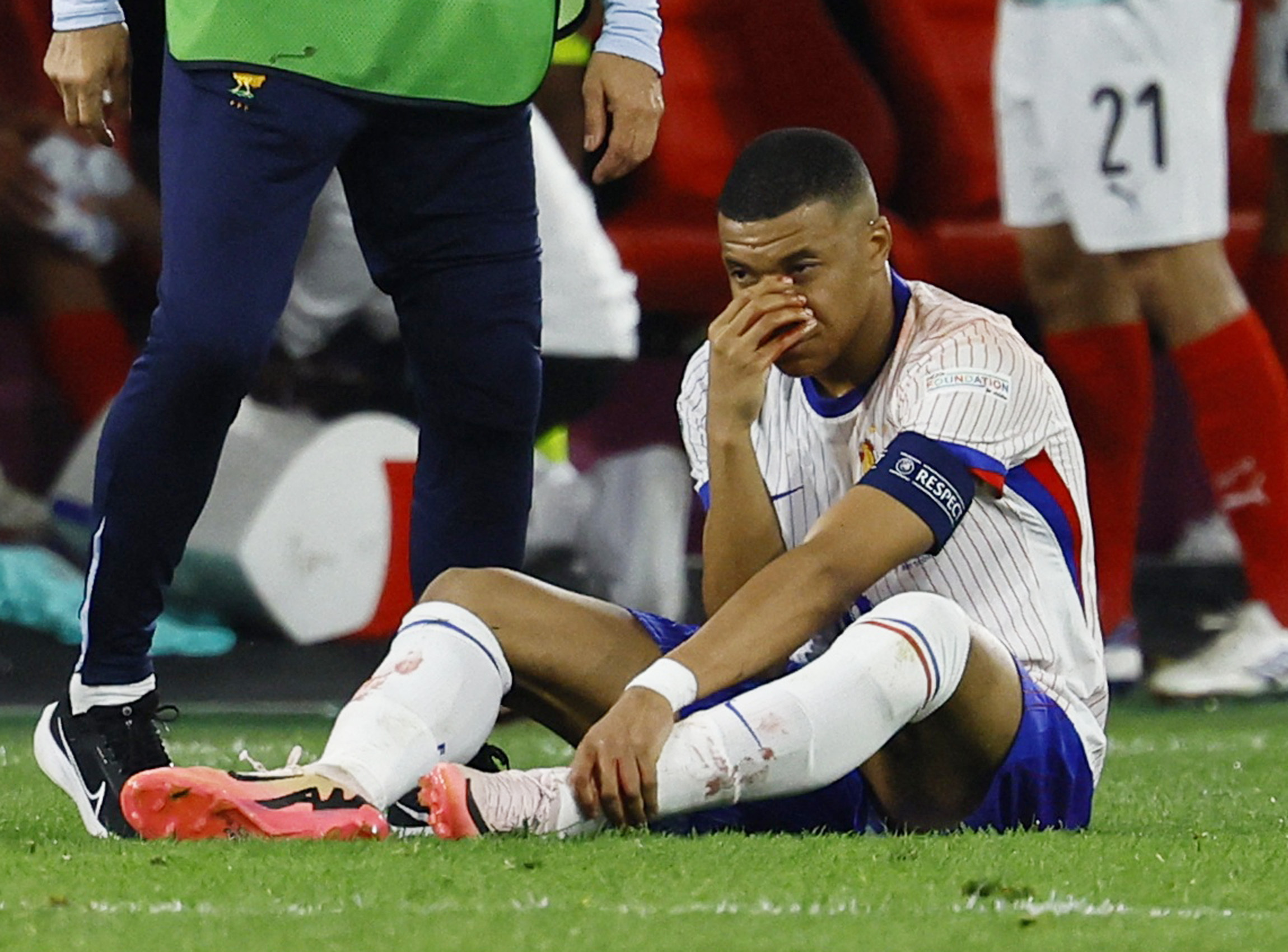 Tuyển Pháp thở phào vì Mbappe không phải phẫu thuật mũi- Ảnh 1.