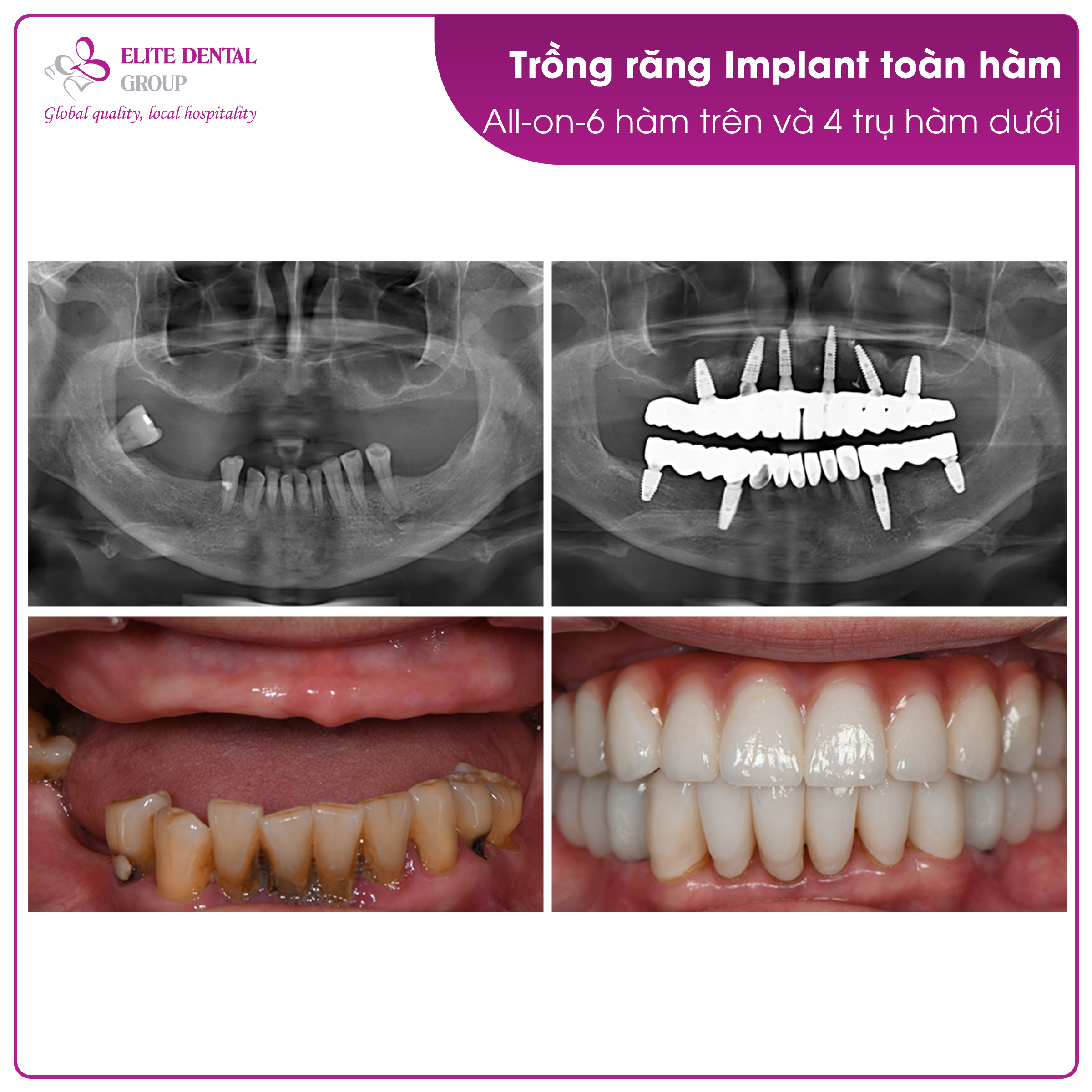 Tận hưởng cuộc sống trọn vẹn tuổi xế chiều nhờ trồng răng Implant to&agrave;n h&agrave;m- Ảnh 3.