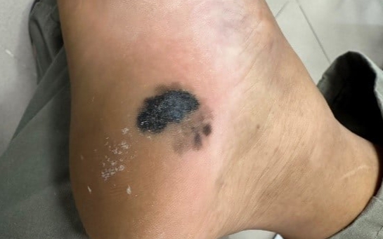 Gót chân đen nhánh, lở loét vì bệnh ung thư nguy hiểm