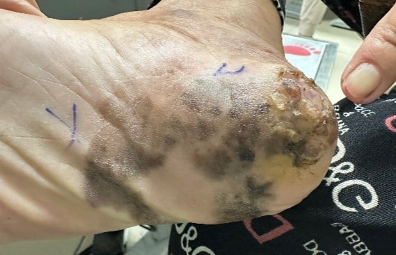 G&oacute;t ch&acirc;n đen nh&aacute;nh, lở lo&eacute;t v&igrave; bệnh ung thư nguy hiểm- Ảnh 2.